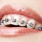Are braces cosmetic dentistry?