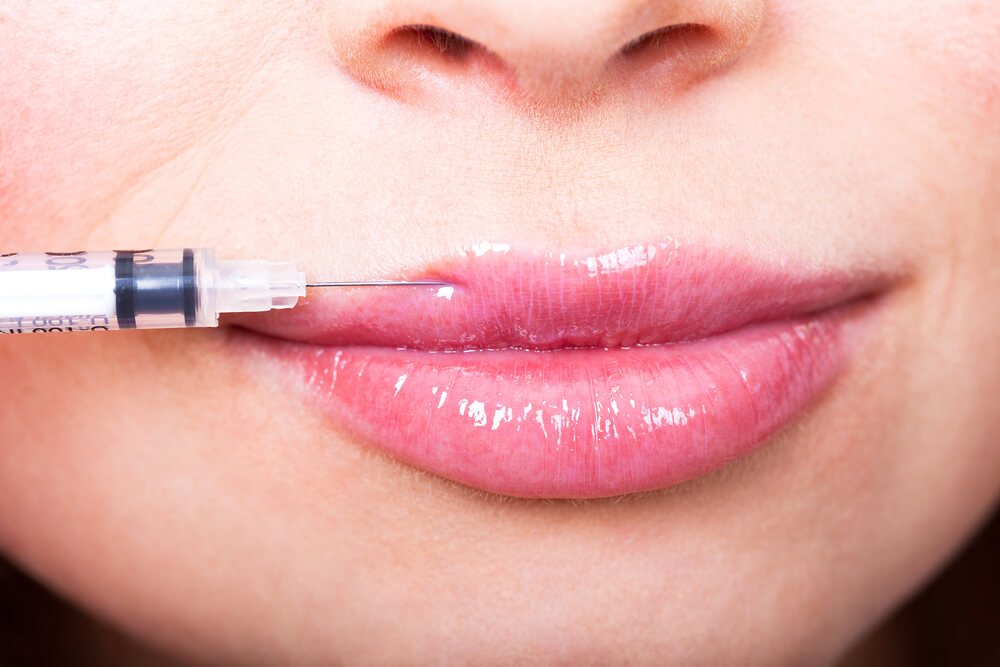Can You Kiss After Lip Filler?
