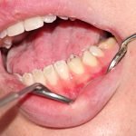 Hypoplasia of tooth enamel