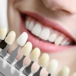 Is Bonding Your Teeth a Good Idea?