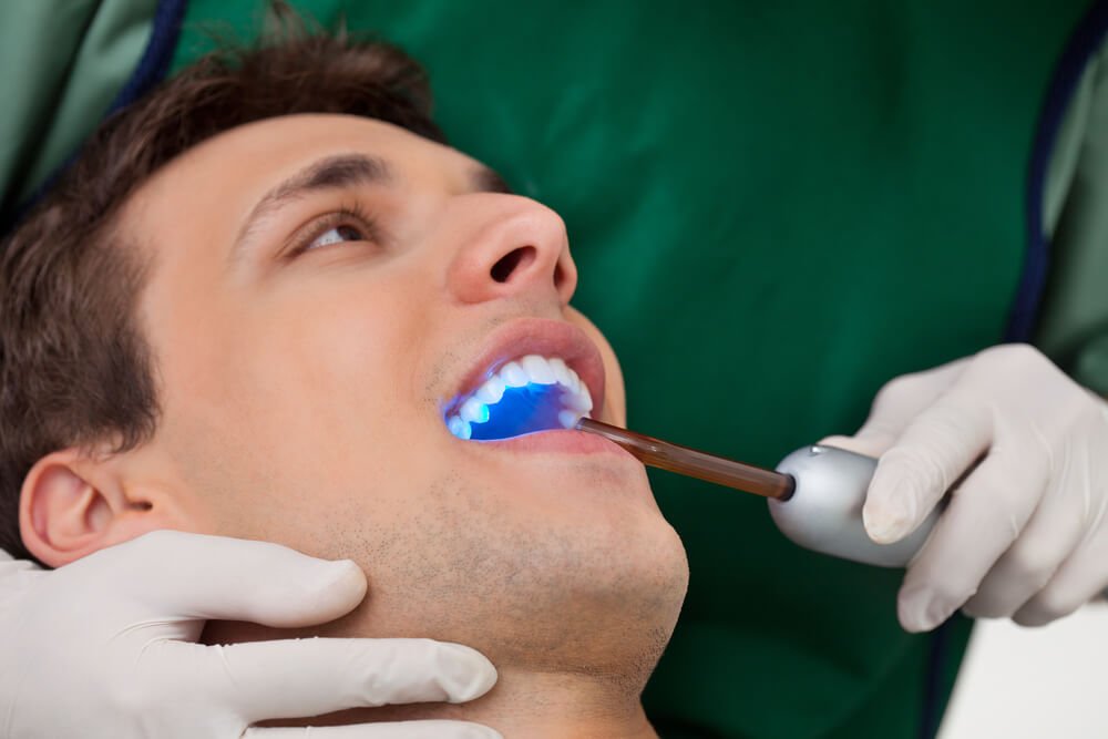 Tooth Bonding Versus Veneers