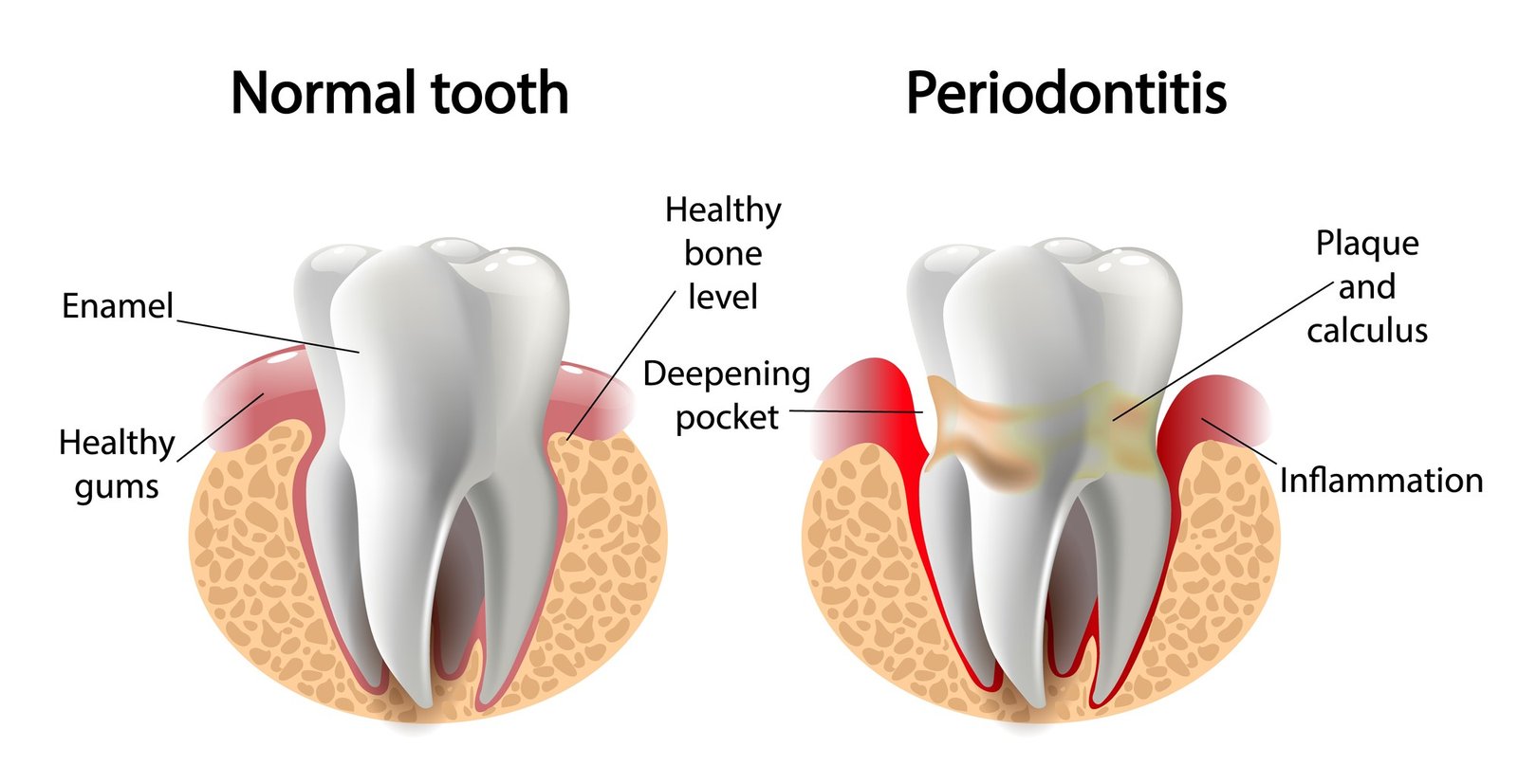 What Causes Periodontal Disease
