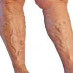 What Causes Varicose Veins