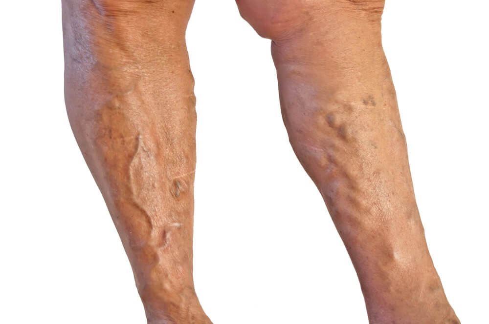 What Causes Varicose Veins