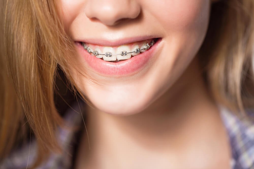 What Helps With Braces Pain?