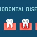 Whаt Iѕ Periodontal Diѕеаѕе